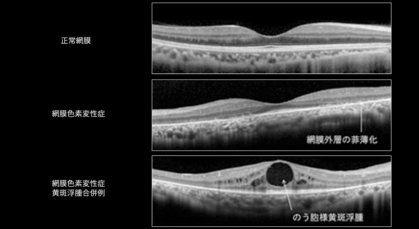 網膜変性疾患診療のすべて - 健康・医学